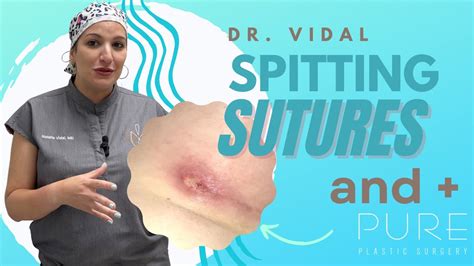 spit healing surgical incision